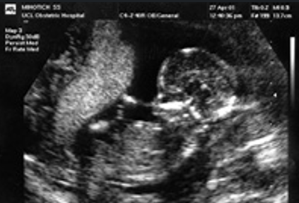 an ultrasound scan of a foetus