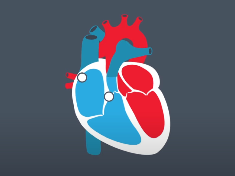 atrial flutter