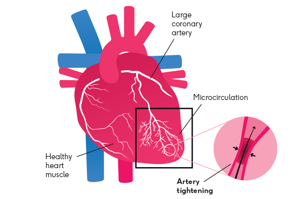 Microvascular angina