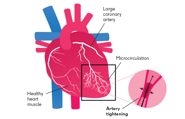 Angina Visual Angina - Causes, symptoms & treatments - BHF