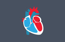 A blood clot forming in the atrium due to atrial fibrillation