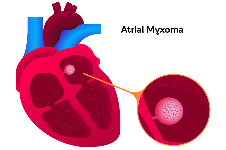 Atrial Myxoma Causes Symptoms And Treatment BHF atrial-myxoma-causes-symptoms-and-treatment-bhf