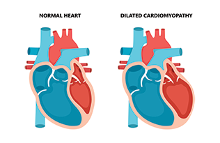 Comparison between a normal heart and a heart with dilated cardiomyopathy