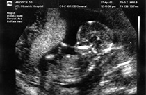 Ultrasound scan