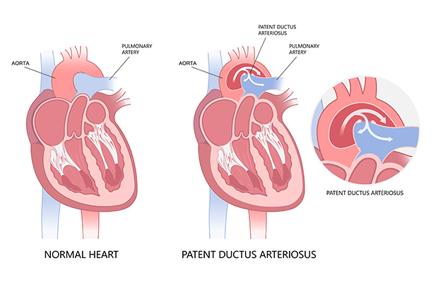 Patent ductus arteriosus (PDA) - BHF