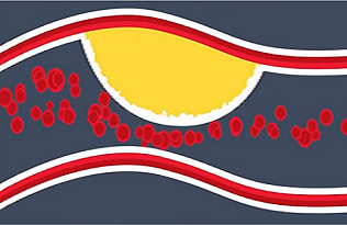 Atherosclerosis - - symptoms, causes, tests, treatments