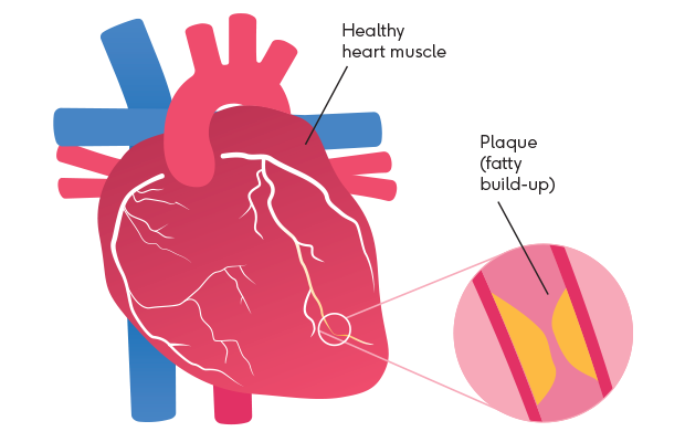 Iluustration showing plaque build-up in coronary artery 