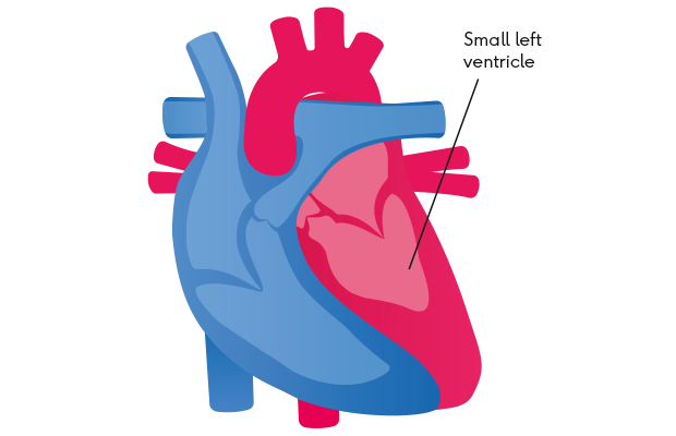 Illustration of a heart with a small ventricle due to heart wall muscle thickening