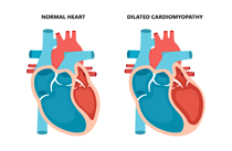 Comparison between a normal heart and a heart with dilated cardiomyopathy