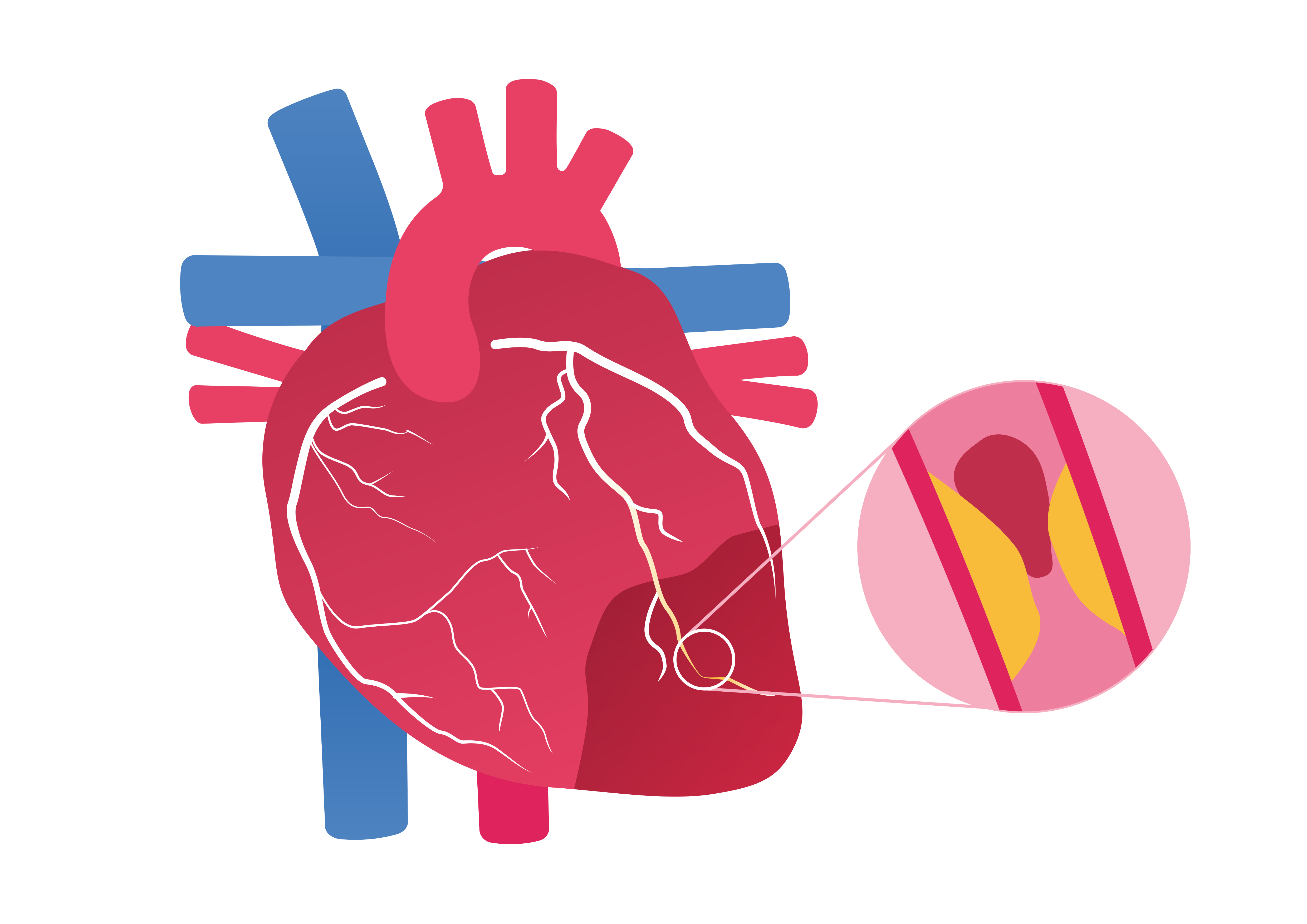 Illustration showing a heart and zoomed in artery that has plaque build up and a blockage causing a heart attack