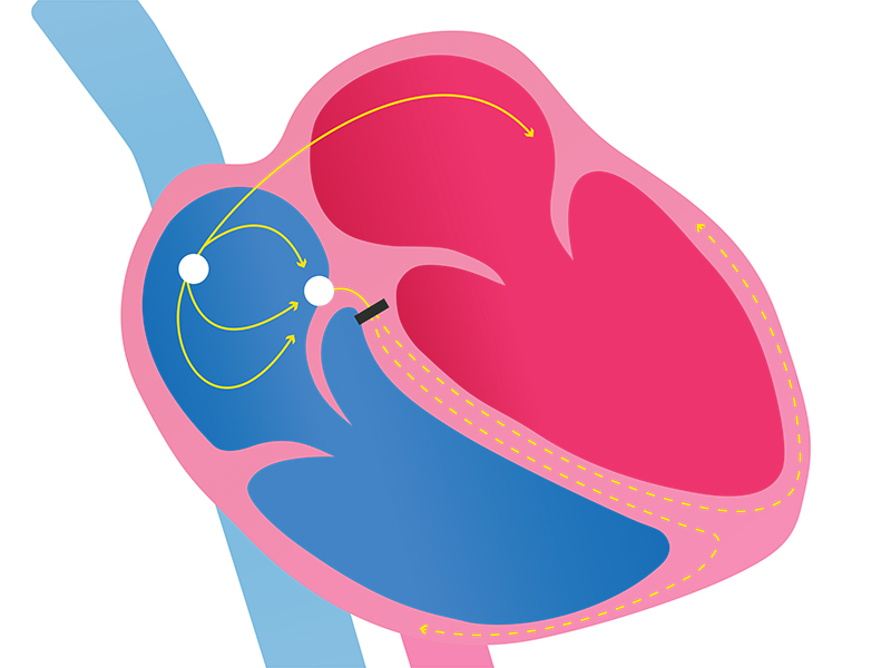 First degree AV Heart block