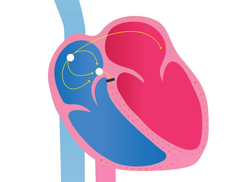 Second degree AV heart block
