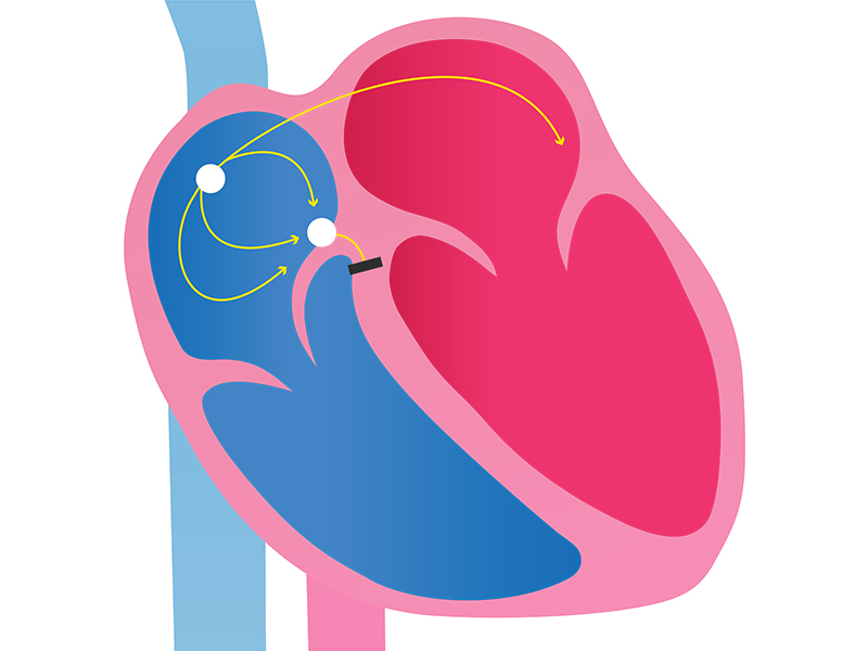 Third degree AV heart block