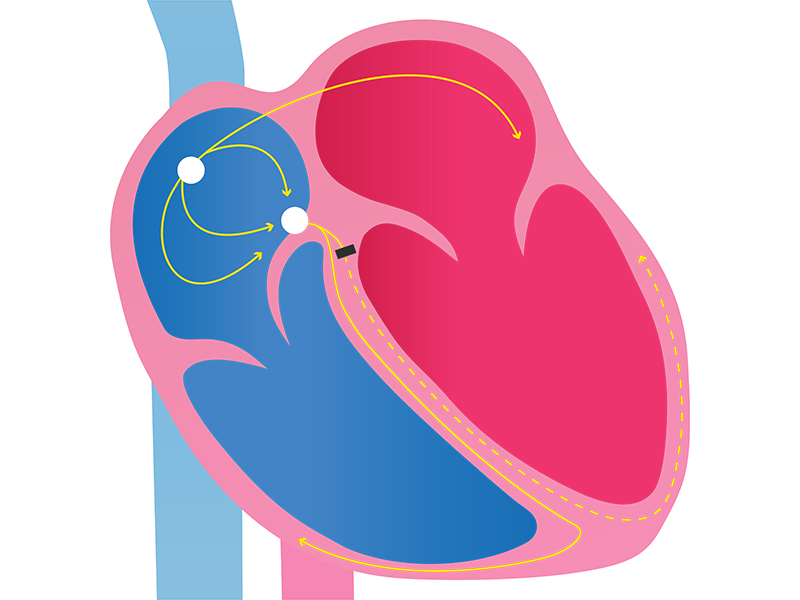 Left bundle branch block