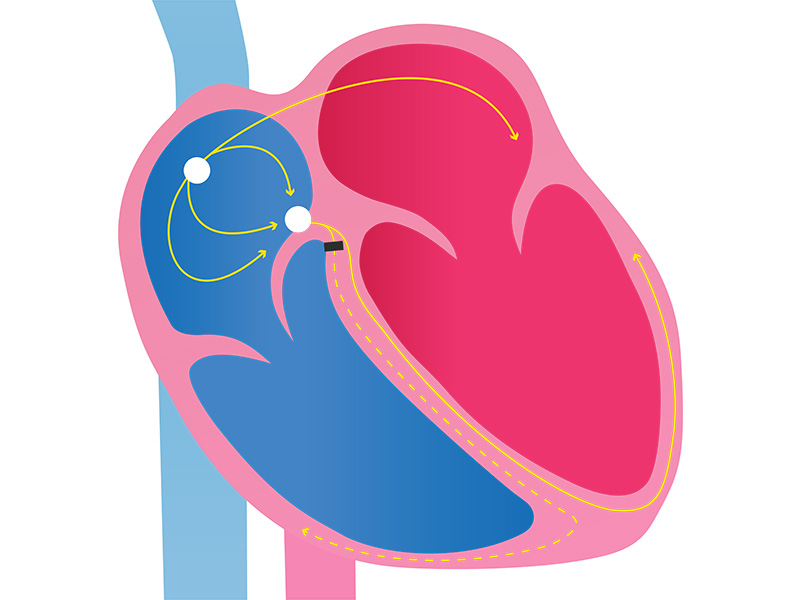 Right bundle branch block 