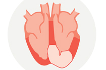 Hypertrophic cardiomyopathy