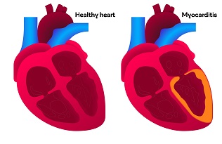 Myocarditis - - symptoms, causes, tests, treatments