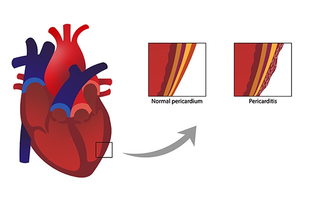 Diagram showing the inflammation caused by pericarditis
