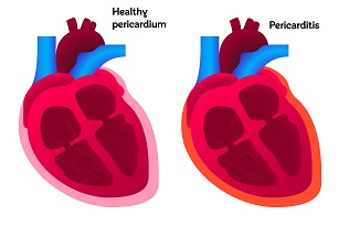 Pericarditis - - symptoms, causes, tests, treatments