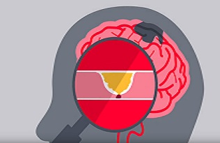 Stroke - causes, symptoms, diagnosis, treatment BHF
