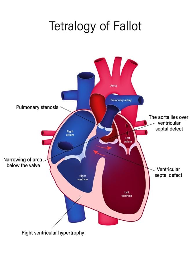Tetralogy of Fallot BHF