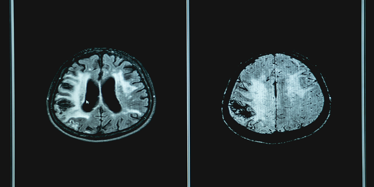 MRI scan of a brain which is affected by vascular dementia