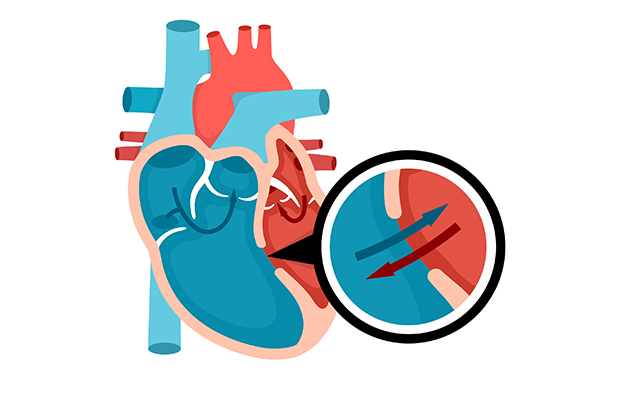 diagram of the heart with a zoom in showing a hole in the wall of the heart