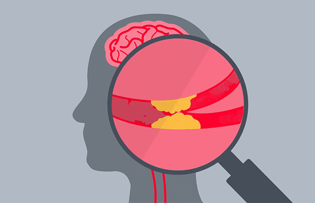 Illustration of a clogged blood vessel in the brain.