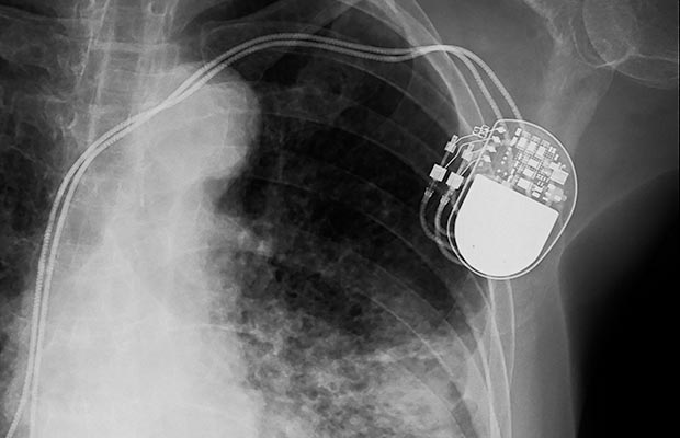 Can a mobile phone interfere with my pacemaker or ICD? - BHF