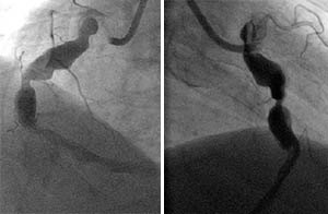 Exploring Coronary Artery Ectasia: Case Reports & Literature Review on Cureus
