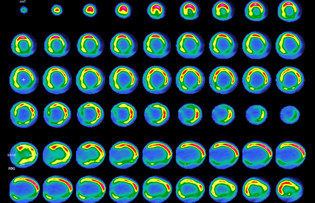 PET scans of the heart