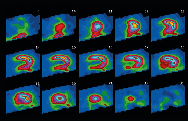 What is a SPECT scan? - Heart Matters - BHF