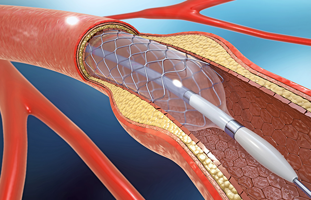 Vector of a stent