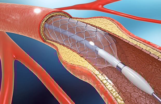 How do stents work? - BHF