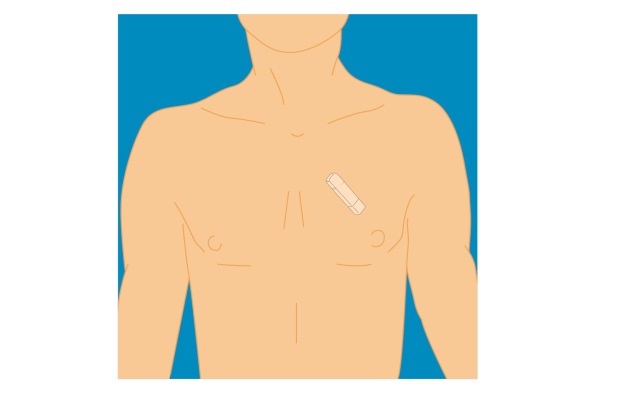The implantable loop torso is implanted in the chest
