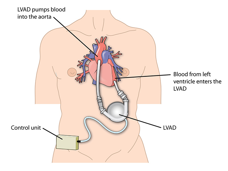 A diagram of a left ventricular assist device (LVAD) attached to the left ventricle of the heart and the aorta.