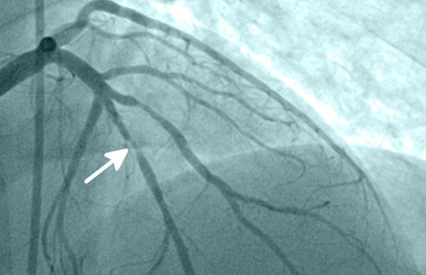 An X-ray of coronary arteries with an arrow pointing to a narrowed section.