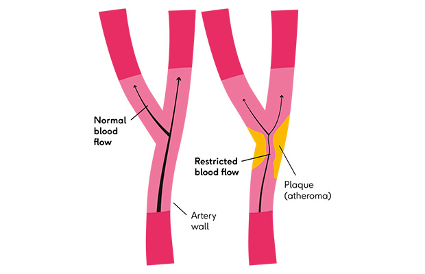 An illustration of arteries with normal and restricted blood flow.
