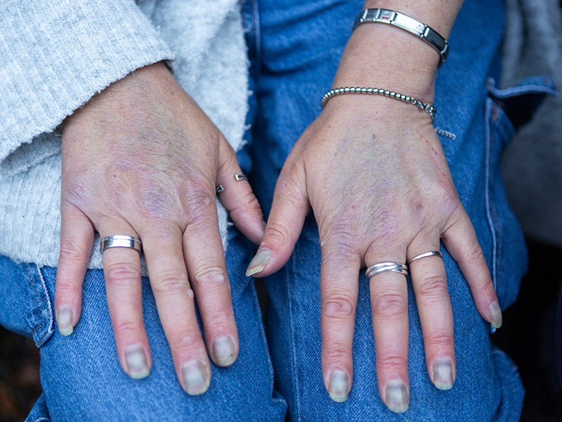 Barbara's hands, with black fingernails caused by her lupus medication.