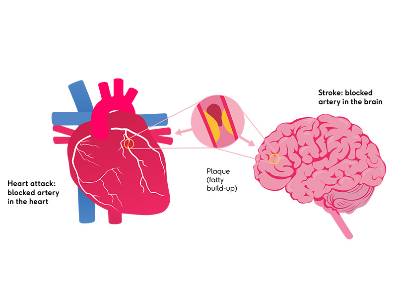 A diagram of a blocked artery in the heart and in the brain.