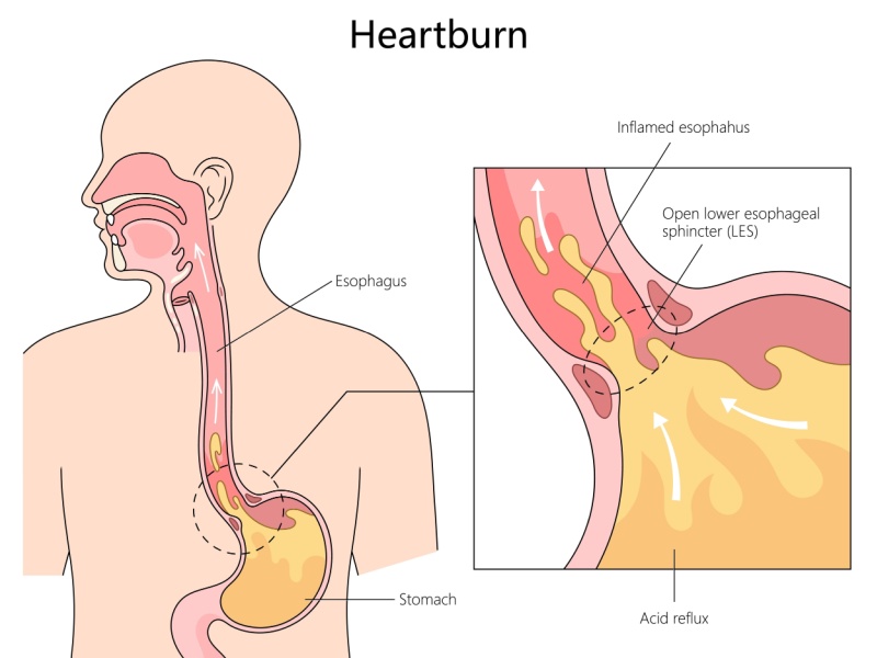 Illustration showing how acid reflux occurs, with acid from the stomach travelling up into the oesophagus (food pipe) when the lower oesophageal sphincter (circular muscle at the top of the stomach) is open.