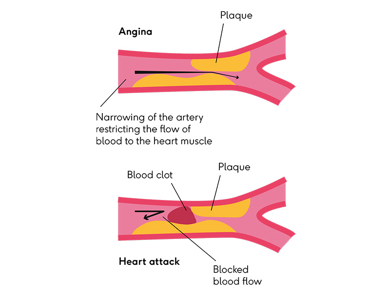 A narrowed artery of someone with angina next to a blocked artery of someone having a heart attack.