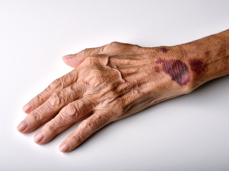 Close up of a senior person's hand with bruising near the wrist, on a white background.