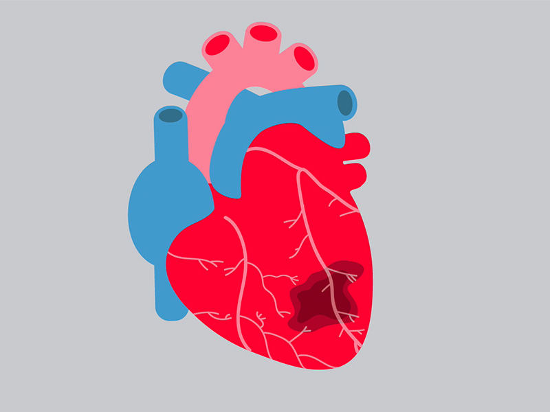 An illustration of a heart that has damaged tissue after a heart attack.