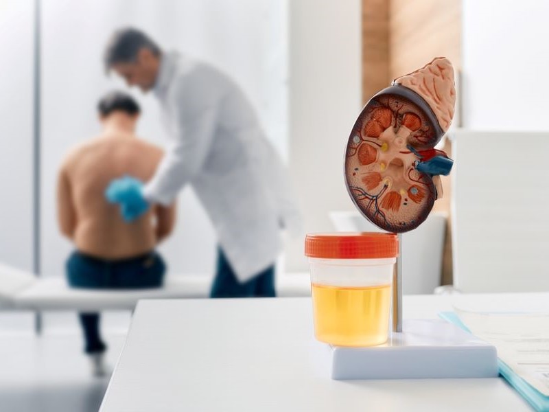 A topless male patient sits on a hospital bed while a doctor in a white coat examines his lower back. In the foreground is a model of the inside of a kidney with a urine sample pot next to it.