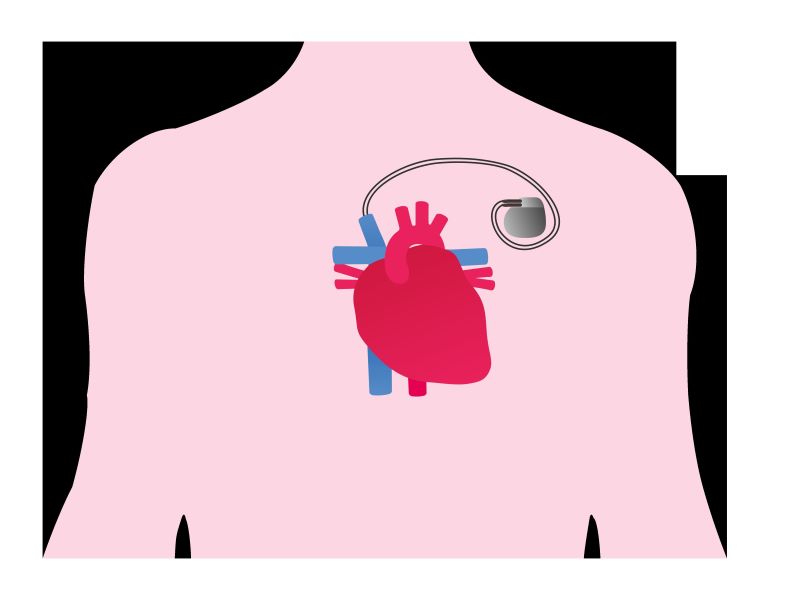 Illustration of a heart with pacemaker inserted
