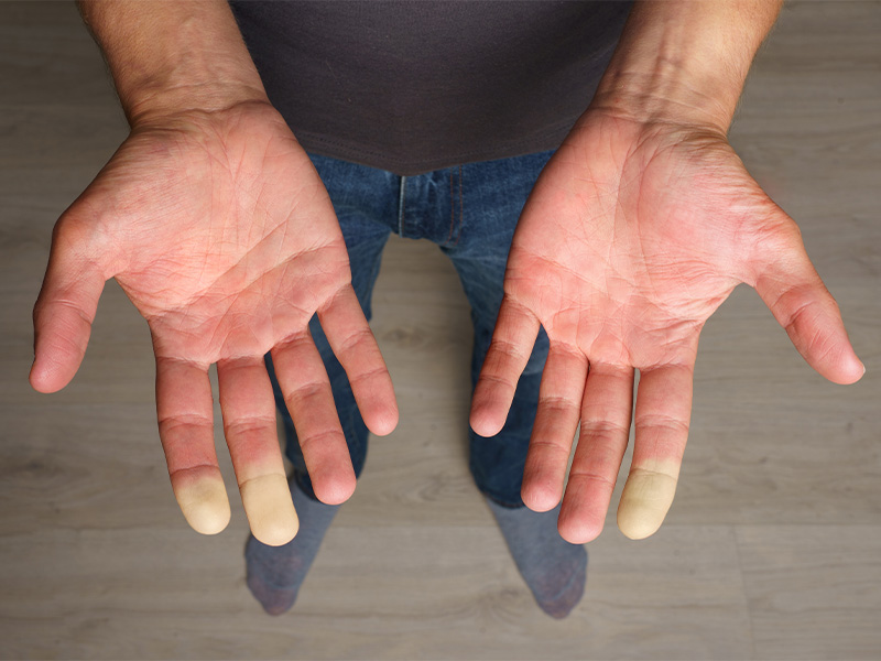 Man showing hands with Raynaud disease