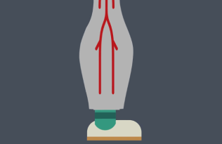 Animation of leg with DVT