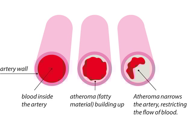 Can heart attack damage be reversed? • MyHeart