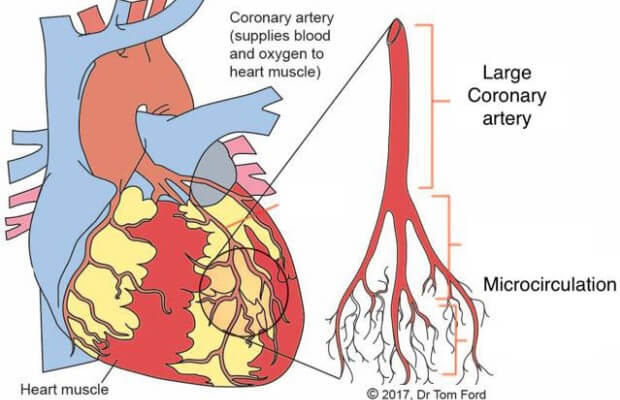 Diagram of microvascular angina, showing the coronary artery and microcirculation